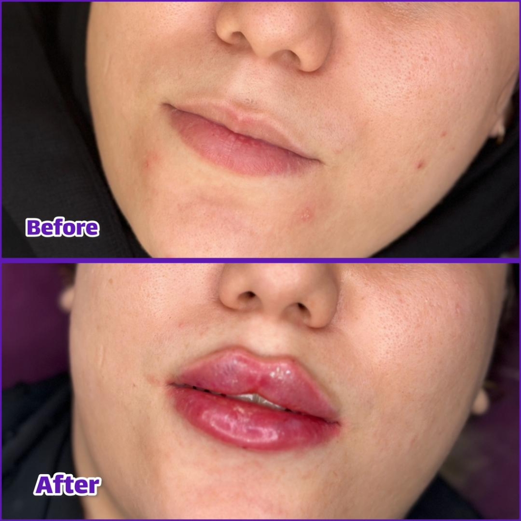 تزریق ژل و بوتاکس